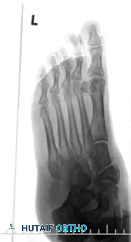 MIDFOOT FRACTURES AND DISLOCATIONS Surgical Diagram