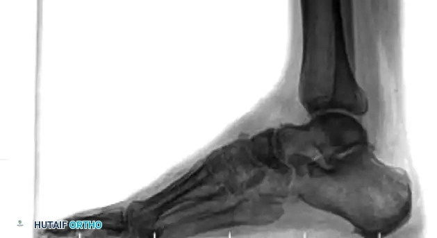 MIDFOOT FRACTURES AND DISLOCATIONS Surgical Diagram