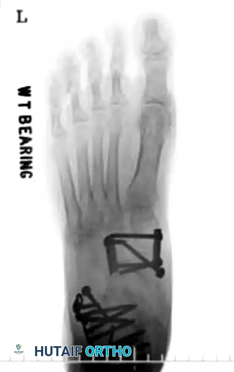 MIDFOOT FRACTURES AND DISLOCATIONS Surgical Diagram