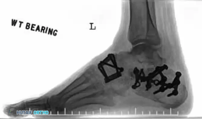 MIDFOOT FRACTURES AND DISLOCATIONS Surgical Diagram