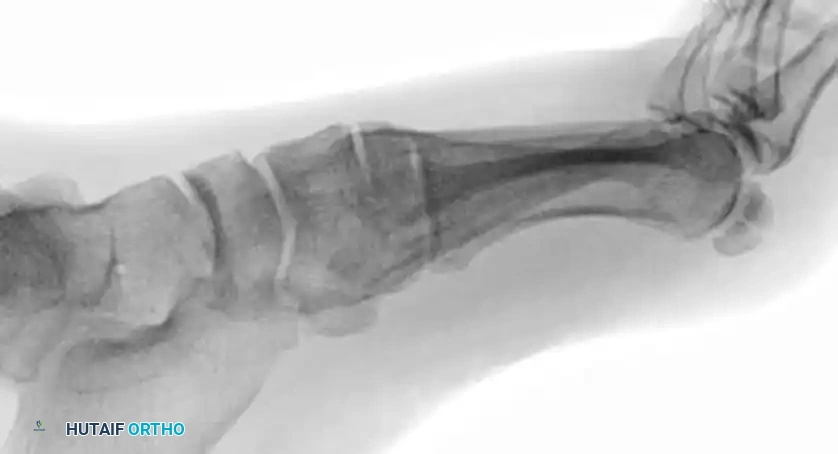 MIDFOOT FRACTURES AND DISLOCATIONS Surgical Diagram