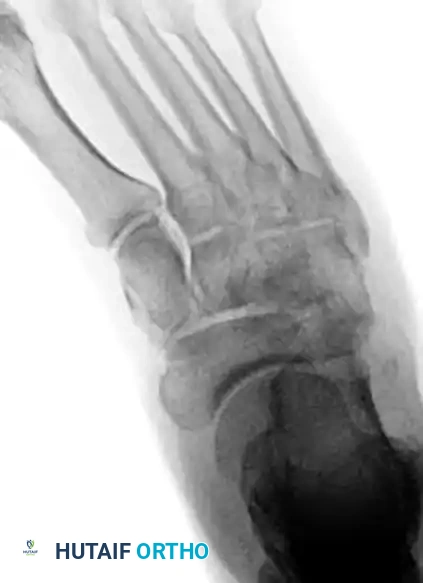 MIDFOOT FRACTURES AND DISLOCATIONS Surgical Diagram