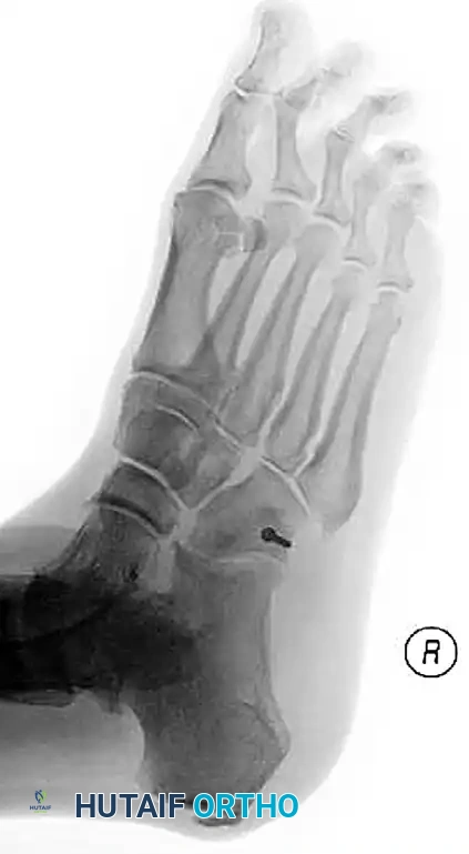 MIDFOOT FRACTURES AND DISLOCATIONS Surgical Diagram