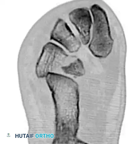 MIDFOOT FRACTURES AND DISLOCATIONS Surgical Diagram