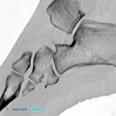 MIDFOOT FRACTURES AND DISLOCATIONS Surgical Diagram