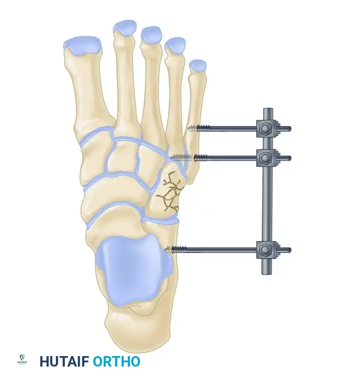 MIDFOOT FRACTURES AND DISLOCATIONS Surgical Diagram