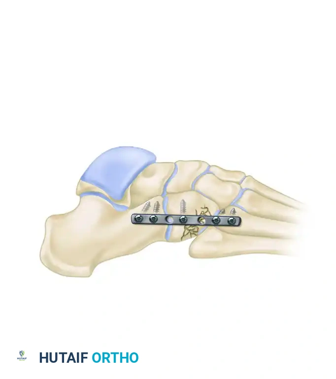 MIDFOOT FRACTURES AND DISLOCATIONS Surgical Diagram