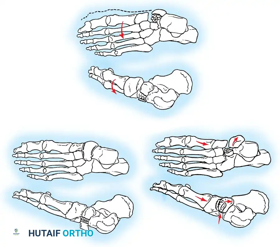 MIDFOOT FRACTURES AND DISLOCATIONS Surgical Diagram