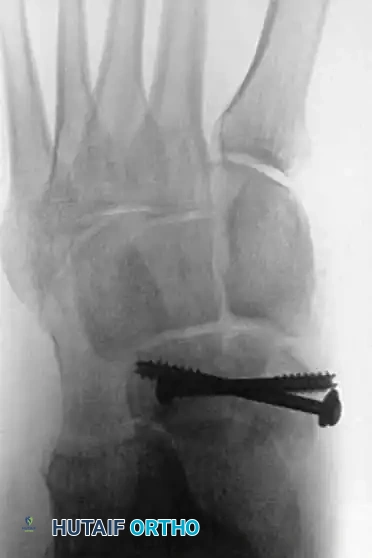 Fig. 86-36 Open reduction and internal fi xation of type III navicular fracture. A and B, Preoperative radiographs. C, Semicoronal CT scan showing comminution of body of navicular. D and E, Postoperative radiographs.