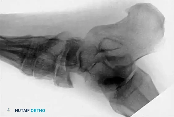 MIDFOOT FRACTURES AND DISLOCATIONS Surgical Diagram