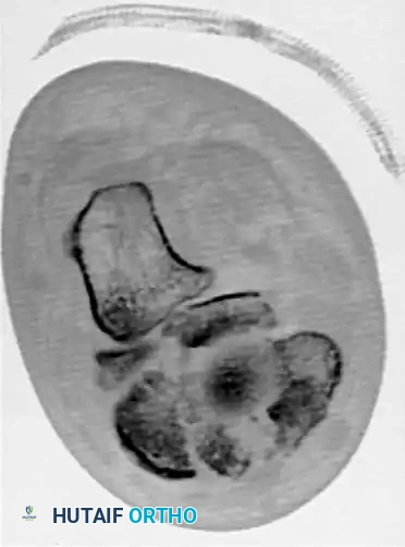 MIDFOOT FRACTURES AND DISLOCATIONS Surgical Diagram