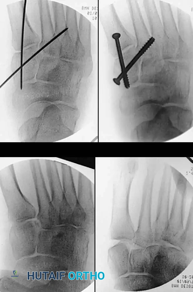 MIDFOOT FRACTURES AND DISLOCATIONS Surgical Diagram