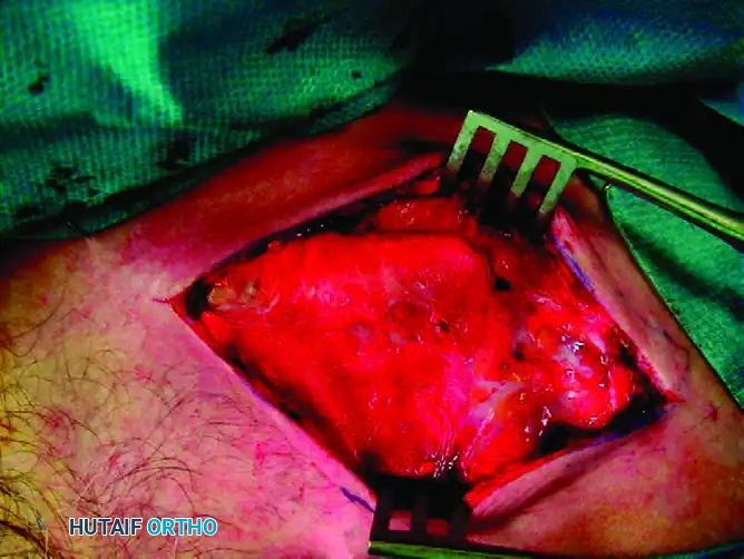 MIDSHAFT MALUNIONS OF THE CLAVICLE Surgical Diagram