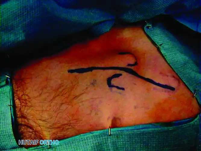 MIDSHAFT MALUNIONS OF THE CLAVICLE Surgical Diagram