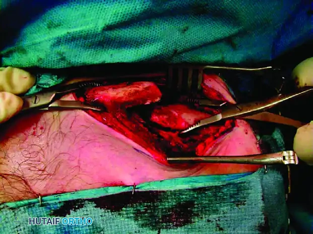 MIDSHAFT MALUNIONS OF THE CLAVICLE Surgical Diagram