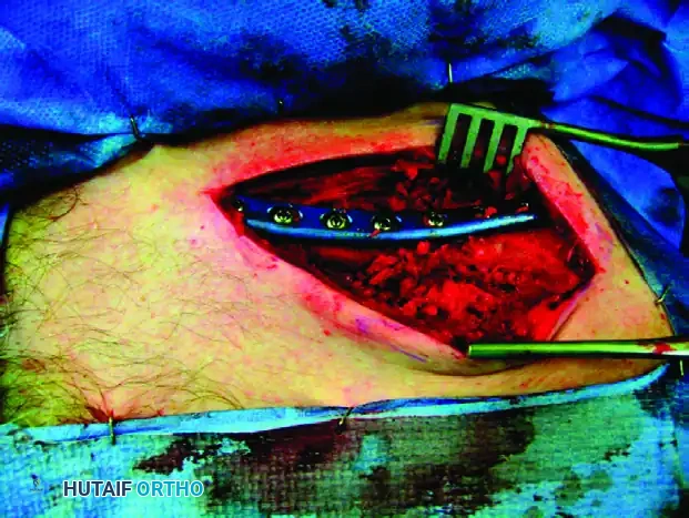 MIDSHAFT MALUNIONS OF THE CLAVICLE Surgical Diagram
