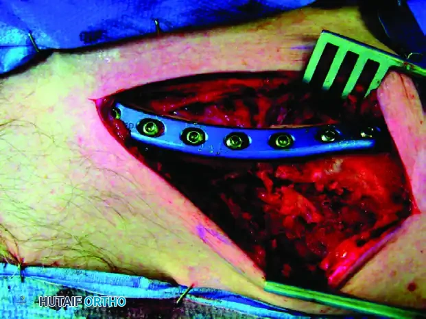MIDSHAFT MALUNIONS OF THE CLAVICLE Surgical Diagram