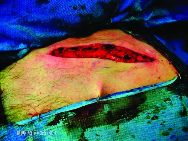 MIDSHAFT MALUNIONS OF THE CLAVICLE Surgical Diagram