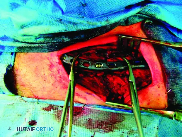 MIDSHAFT MALUNIONS OF THE CLAVICLE Surgical Diagram