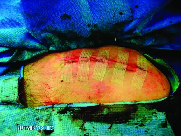 MIDSHAFT MALUNIONS OF THE CLAVICLE Surgical Diagram