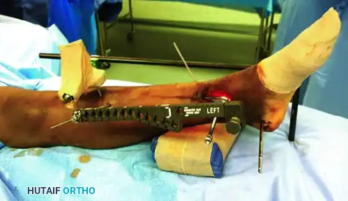 MINIMALLY INVASIVE PLATING OF TIBIAL PILON FRACTURE Surgical Diagram