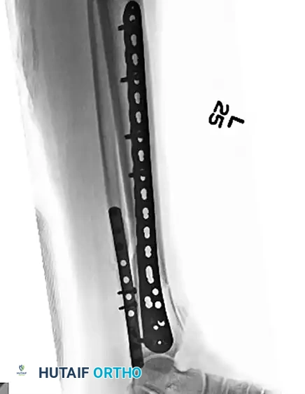 MINIMALLY INVASIVE PLATING OF TIBIAL PILON FRACTURE Surgical Diagram