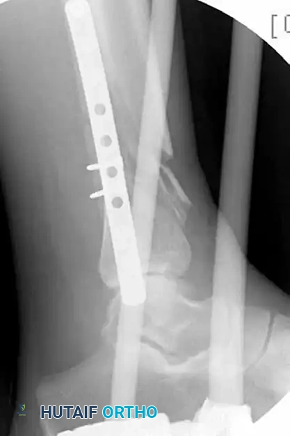 MINIMALLY INVASIVE PLATING OF TIBIAL PILON FRACTURE Surgical Diagram