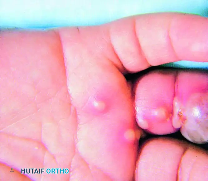 MISCELLANEOUS AND UNUSUAL INFECTIONS Surgical Diagram