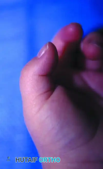 Pediatric Hand Anomalies: Surgical Management of Congenital Trigger Digits and Constriction Ring Syndrome