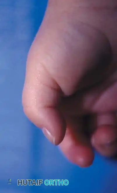 Comprehensive Surgical Management of Pediatric Hand Anomalies: Congenital Trigger Digits and Camptodactyly