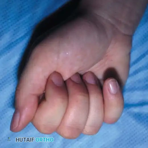 التأهيل الحركي للإصبع