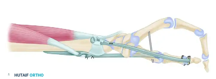 Brachioradialis or extensor carpi radialis longus