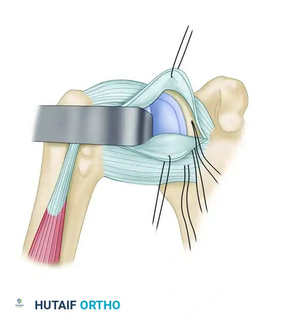 Superior Flap Advancement