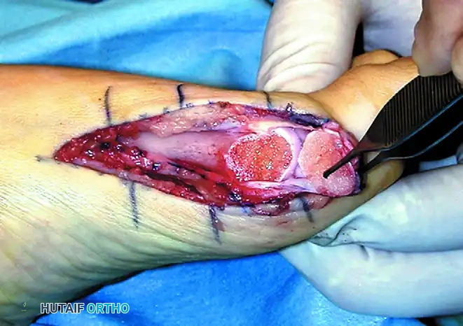 Marking the U-Shaped Periosteal Flap