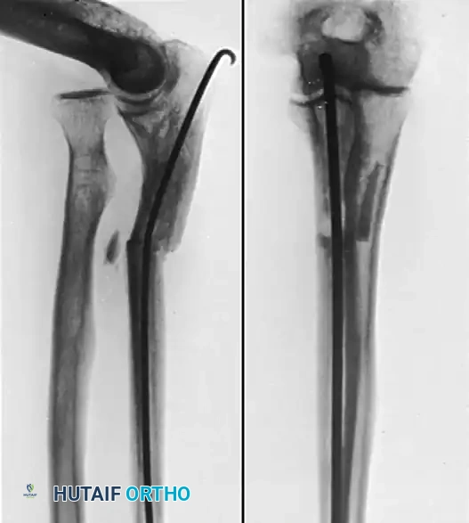 Comprehensive Surgical Management of Monteggia Fractures and Proximal Radioulnar Synostosis