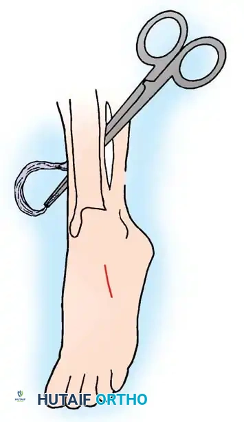 MUSCULAR DYSTROPHY Surgical Diagram