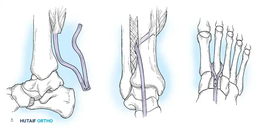 MUSCULAR DYSTROPHY Surgical Diagram