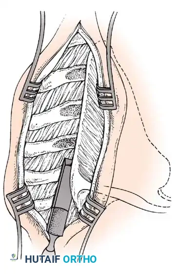 MUSCULAR DYSTROPHY Surgical Diagram