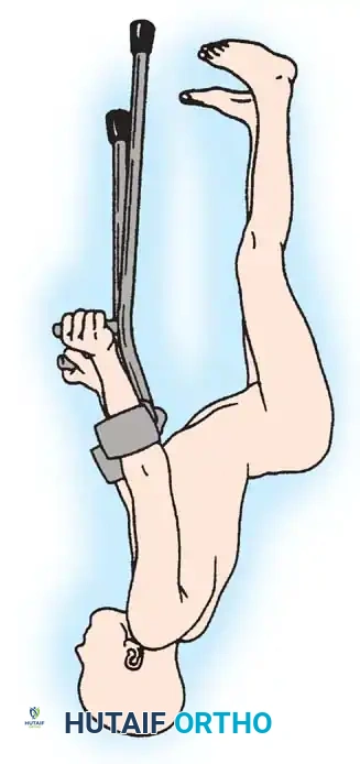 Distal Femoral Extension Osteotomy