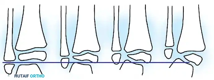 Kyphectomy Surgical Approach