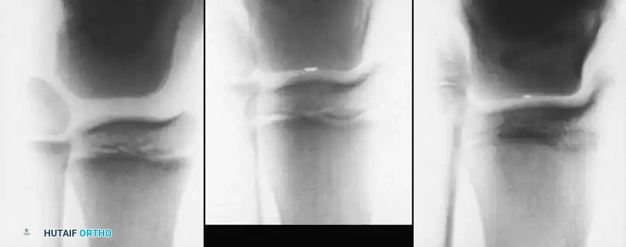 Pelvic Fixation Biomechanics