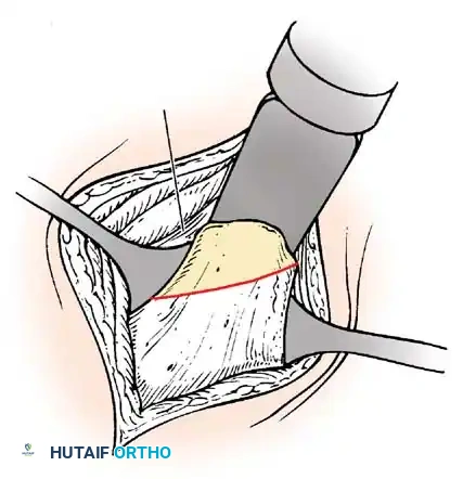 Clubfoot Clinical Presentation