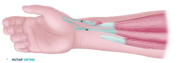 MYOTOMY Surgical Diagram