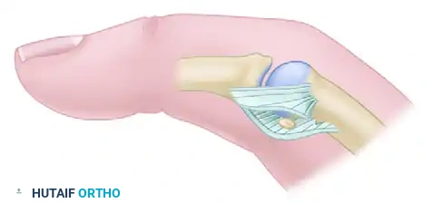 MYOTOMY Surgical Diagram
