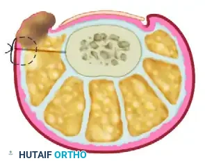 NAIL FOLD REMOVAL OR REDUCTION Surgical Diagram