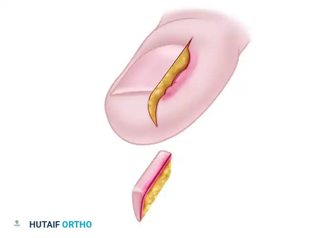 FIGURE 87-18 Soft tissue wedge resection for ingrown toenail. A, Triangular section is removed from lateral aspect of nail groove. B, Cross-section after removal. C, Nail lip and groove are pulled down after nail margins are sutured. D, Cross-section after suturing.