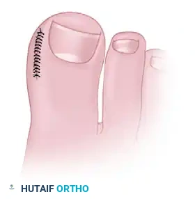 NAIL FOLD REMOVAL OR REDUCTION Surgical Diagram
