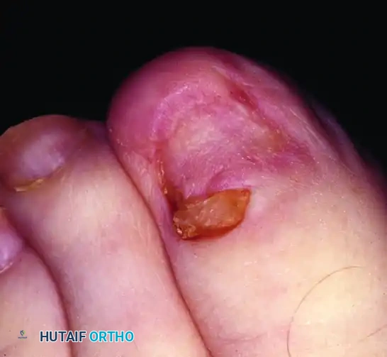 FIGURE 87-17 Watson-Cheyne technique of wedge resection. SEE TECHNIQUE 87-6 .