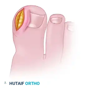 NAIL FOLD REMOVAL OR REDUCTION Surgical Diagram