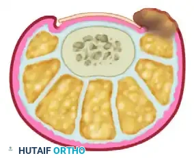 FIGURE 87-16 Recurrence of nail spicules after wedge resection.